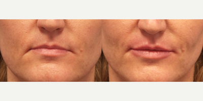Lip Fillers before and after photo