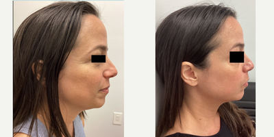 Microneedling before and after photo