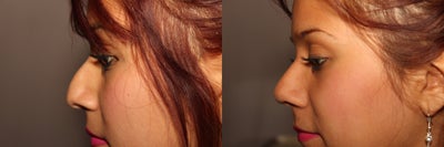 Rhinoplasty before and after photo
