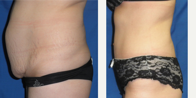 Tummy Tuck before and after photo