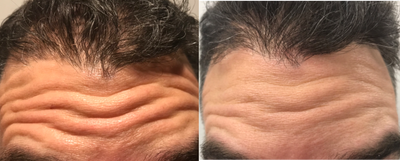 Botox before and after photo