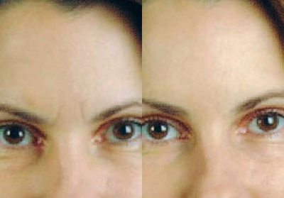 Botox before and after photo