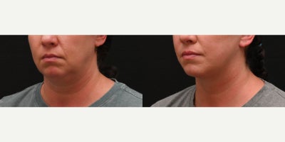 Facelift before and after photo
