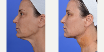 Neck Lift before and after photo