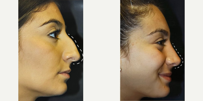 Rhinoplasty before and after photo