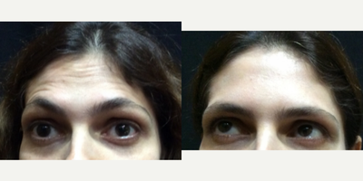 Botox before and after photo