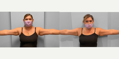 CoolSculpting before and after photo