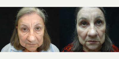 Eyelid Surgery before and after photo