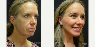 Facial Fat Transfer before and after photo