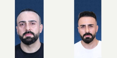 before and after image
