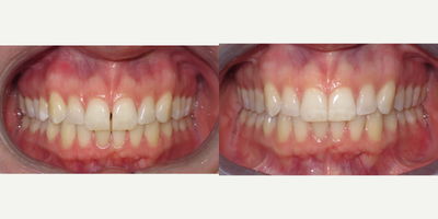 Invisalign before and after photo