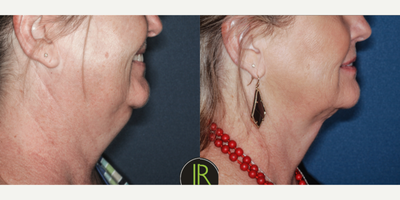 Liposuction before and after photo