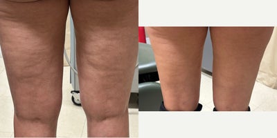 Cellulaze before and after photo