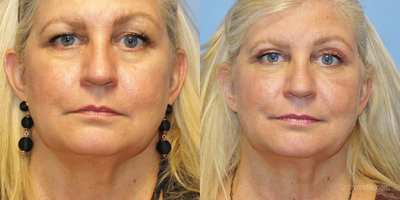 Eyelid Surgery before and after photo