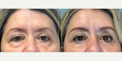 Eyelid Surgery before and after photo