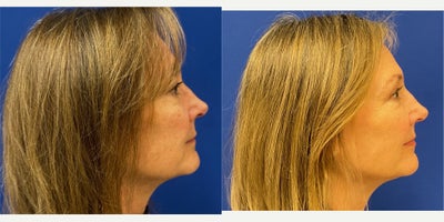 before and after image