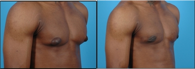 Gynecomastia Surgery before and after photo