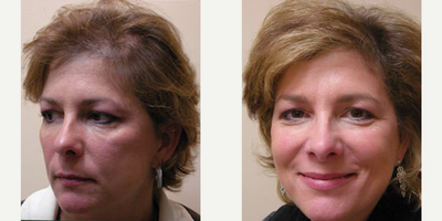 Hair Loss Treatment before and after photo