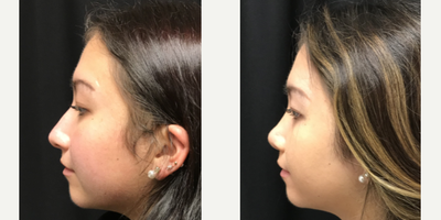 Rhinoplasty before and after photo