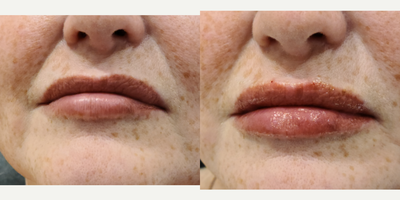 Juvederm before and after photo