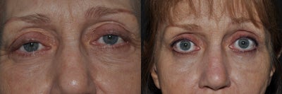Permanent Makeup before and after photo