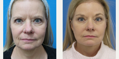 Brow Lift before and after photo