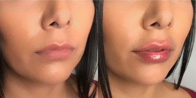 Dermal Fillers before and after photo