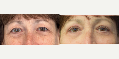 Eyelid Surgery before and after photo