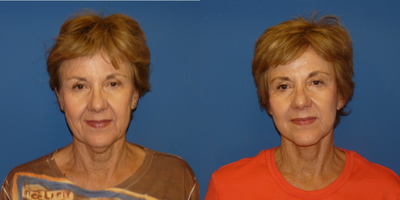 Facelift before and after photo