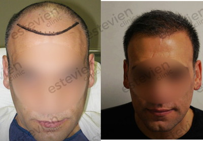 FUE Hair Transplant before and after photo