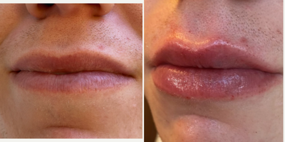 Lip Fillers before and after photo