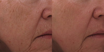 ProFractional Laser before and after photo