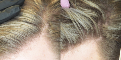 PRP for Hair Loss before and after photo
