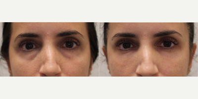 Restylane before and after photo