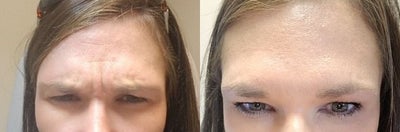 Botox before and after photo