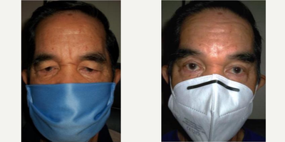 Brow Lift before and after photo