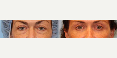 Eyelid Surgery before and after photo