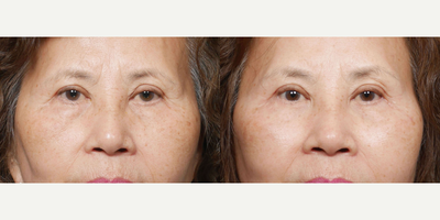 Eyelid Surgery before and after photo