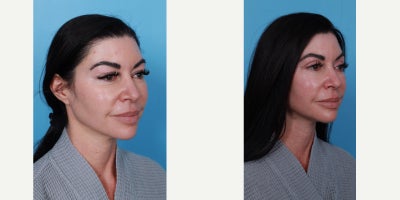 Facial Fat Transfer before and after photo