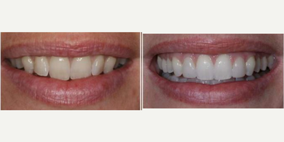 Invisalign before and after photo