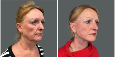 Neck Lift before and after photo