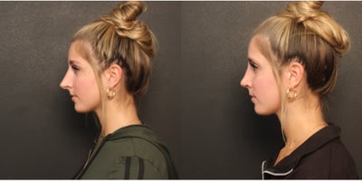 Revision Rhinoplasty before and after photo