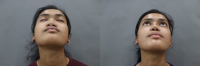 Rhinoplasty before and after photo