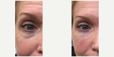 Belotero before and after photo