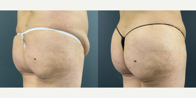 Brazilian Butt Lift before and after photo