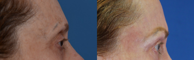 Facial Fat Transfer before and after photo