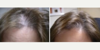 Hair Loss Treatment before and after photo