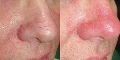 IPL before and after photo
