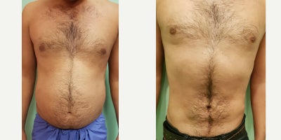 Liposuction before and after photo