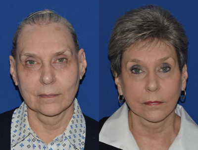 Mini Facelift before and after photo